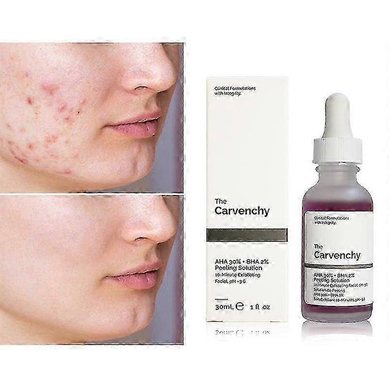 AHA 30% + BHA 2% Peelinglösning, AHA 30% BHA 2% Exfolierande Vätska, AHA 30% BHA 2% Peelinglösning Kemisk Peeling för Ansikte BHA AHA Mask 2025