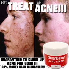 Krämer Acnebehandlingar Fresh acne cream lotion high strength ingredients