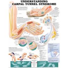 Understanding Carpal Tunnel Syndrome