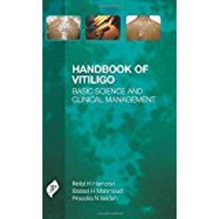 Handbook of Vitiligo