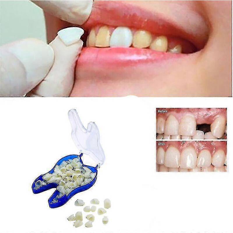 Teeth whitening kit Temporary Tooth Repair Kit Solid Whitening