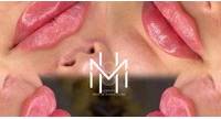 Injection Dermal Filler