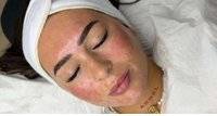 Micro Needling