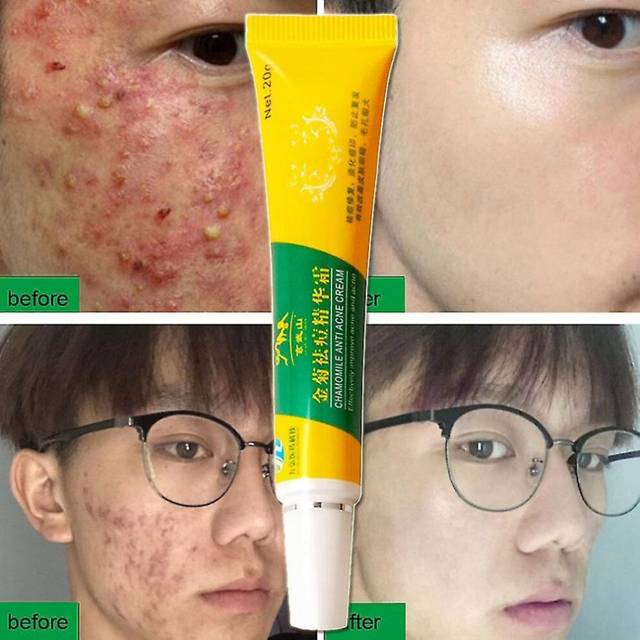 Chamomile Effective Acne Removal Cream Acne Treatment Fade Acne Spots Oil Control Shrink Pores Whitening Moisturizing Acne Cream