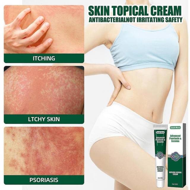 Herbal Ointment Perfect For Eczema Dermatitis Psoriasis Treatment Cream External Use