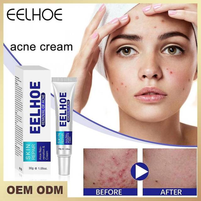 Acne Cream Purifying Acne And Fading Acne Marks Water-oil Balance Acne Cream Moisturizing And Hydrating Face Cream